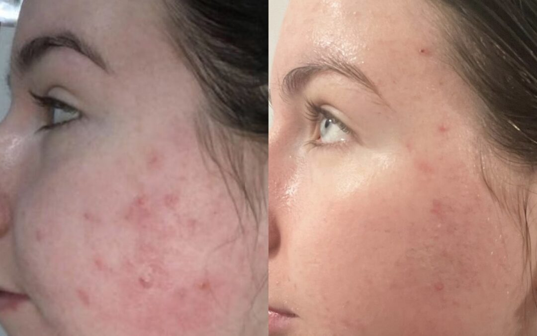 Is collagen a remedy for acne? Read Kayleigh’s experience of taking DermaShotz for hormonal acne